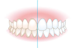 ホワイトニング